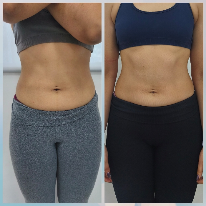 Resultado Real de Estética Corporal Joana Cardoso