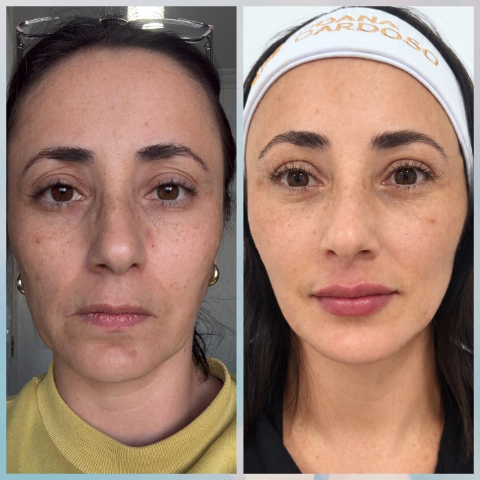 Gerenciamento de Pele e Bioestímulo de Colágeno Joana Cardoso