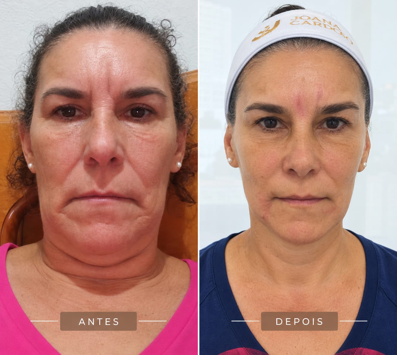 Antes e depois Rejuvenescimento Facial Joana Cardoso