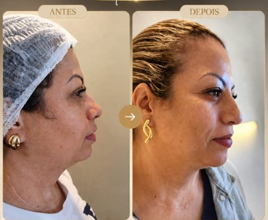 Definição Mandibular e Perfiloplastia Joana Cardoso